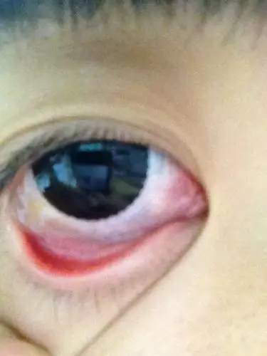 下眼睑有一层透明像果冻一样的东西 是什么