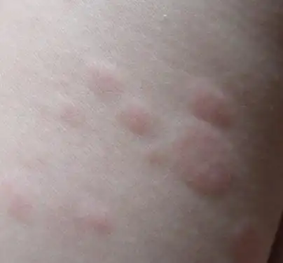 皮肤长这些东西怎么办?