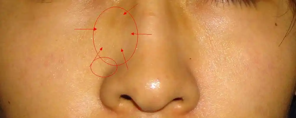 左侧鼻骨突起 ct上写着左侧鼻骨形态欠规整 跟右边