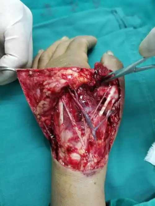 术中清创后照片