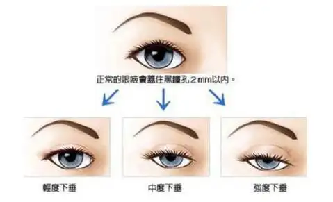 上睑松弛矫正可有效治疗松弛情况吗