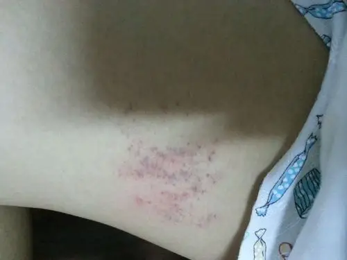 大腿内侧淤青