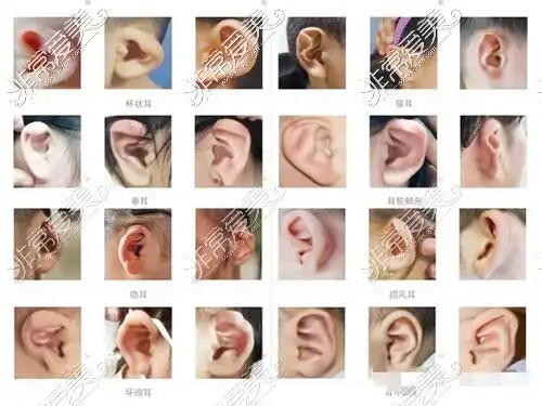 需要整形的耳朵图片大全耳朵畸形整形方式及耳修复好医院