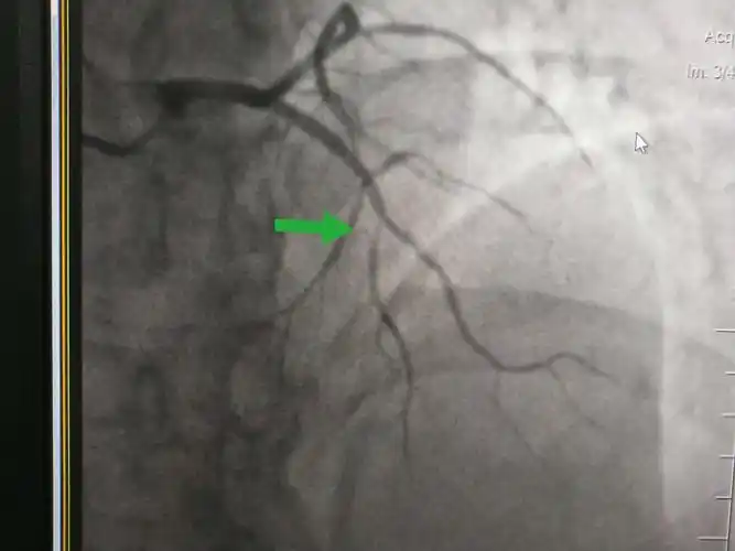 冠脉造影提示:左冠状动脉的前降支也有重度狭窄