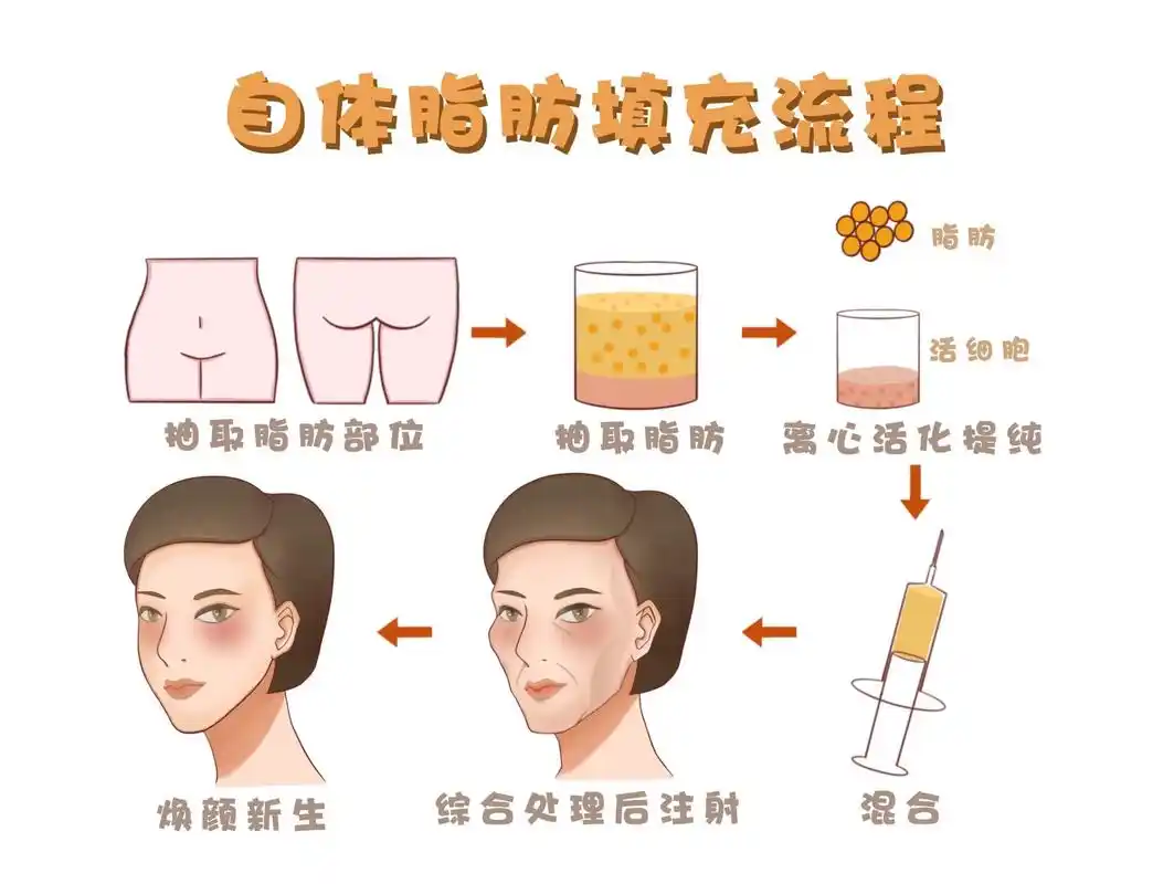 脂肪填充面部凹陷