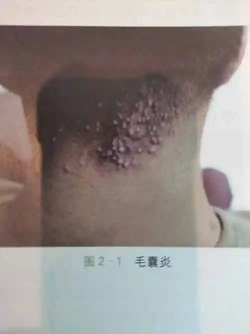 毛囊虫怎么治疗毛囊炎可以根治吗