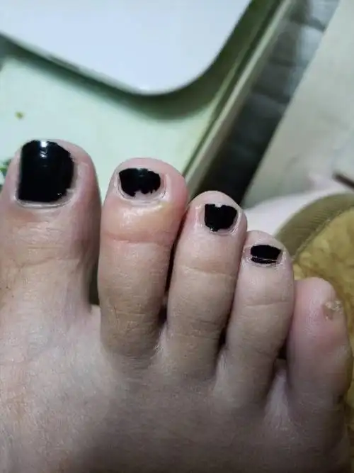 脚趾头长了透明水泡很痒