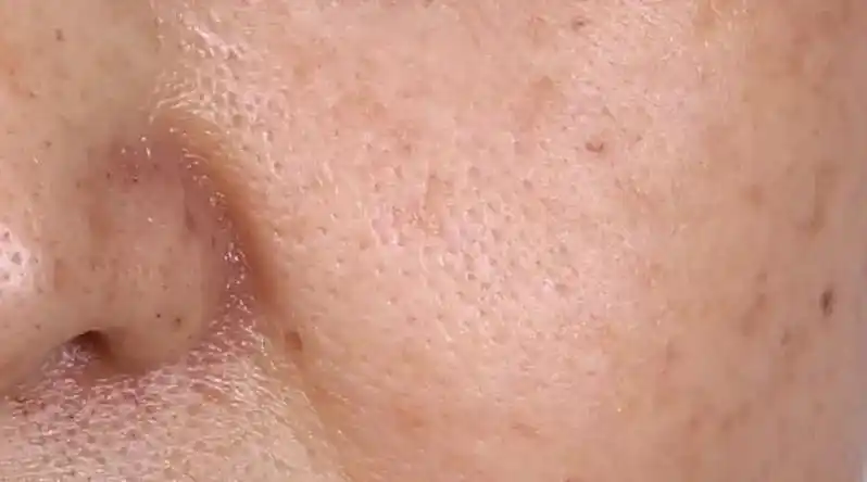 诱因(专业版):衰老引起的毛孔粗大,主要原因是自然老化和光老化.