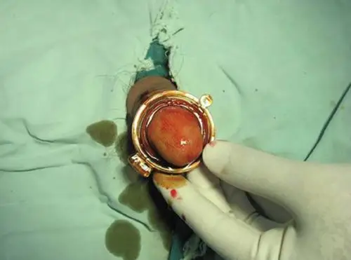 包皮过长手术环切图片包皮过长手术用探针图片包皮过长手术缝合图片