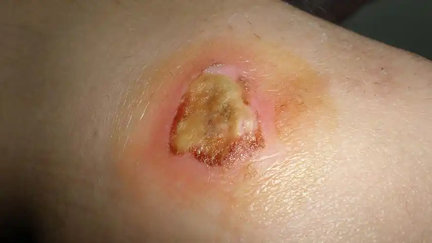 膝部擦伤感染,表皮坏死,部分坏死表皮可以掀起,约2*2cm,创面处理?