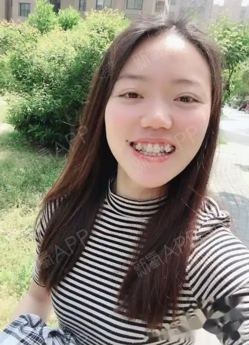 虎牙矫正220天了,侧面比之前好不少