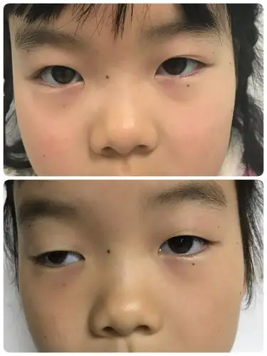 先天性上睑下垂