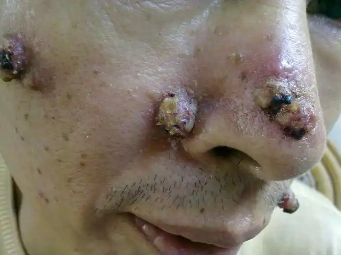 求助:脸部长了肉瘤,医院鉴定为炎性坏死组织.