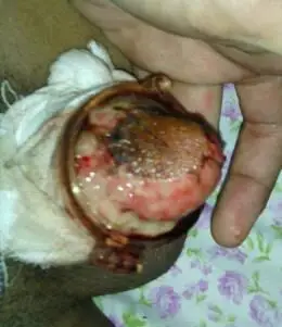 1月10日在省公立三甲医院泌尿外科做的包皮手术,医生是用手术切除了