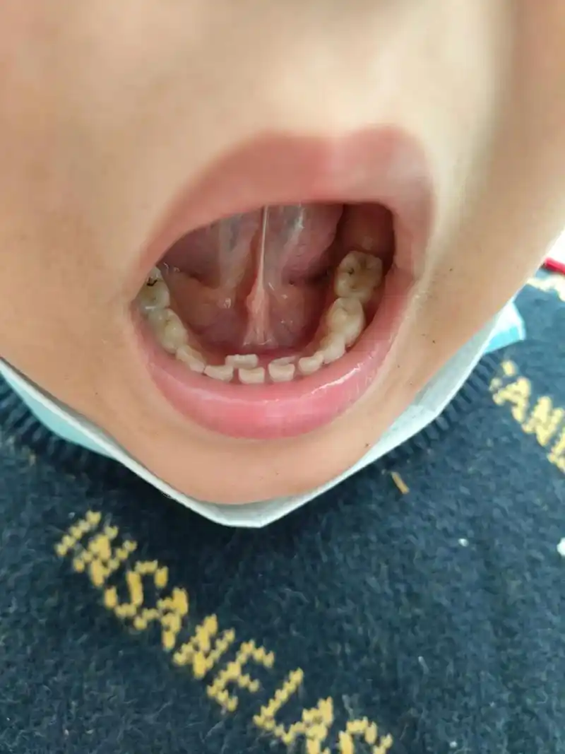 双排牙齿通常是已经长出恒牙,但是相应的乳牙还没有退掉 - 抖音