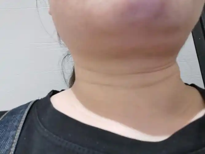 没效果,一个多月了,下巴那里一坨肉凸出的特别明显,_圈子-新氧美容