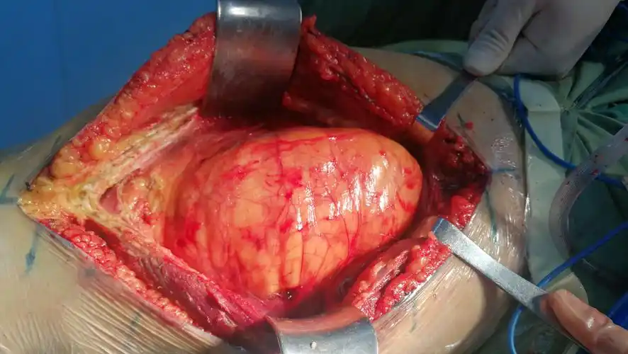 右大腿巨大肿瘤