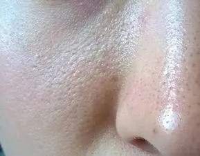 怎样判断脸上有角质?皮肤经常补水也需要去角质吗.