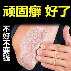 李氏百草膏皮肤癣药膏牛皮癣银屑癣外用鲜藓治疗手足藓体股藓止痒