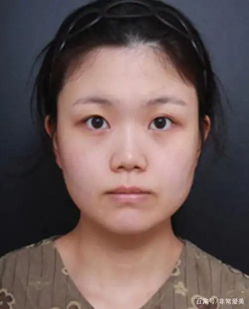 而侧面,鼻子的缺陷更突出了,没有山根鼻梁,再加上苹果肌扁平,显得整个