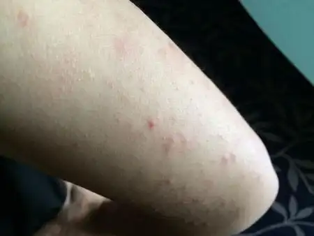 手臂上长的是什么啊?挤的话就有白色的东西,都好几年了.