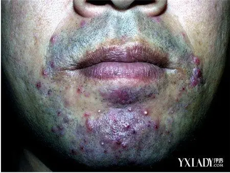 脸部毛囊炎怎么处理 3种治疗方案可以帮助你