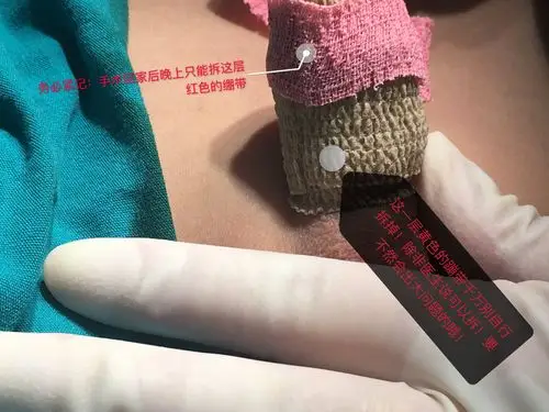 包皮吻合器手术后拆绷带事项提醒原创