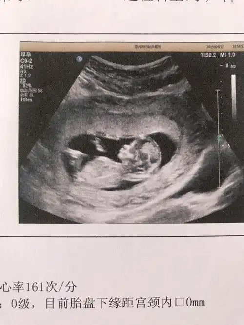 昨天做的nt顺利通过,看图片像个女宝宝