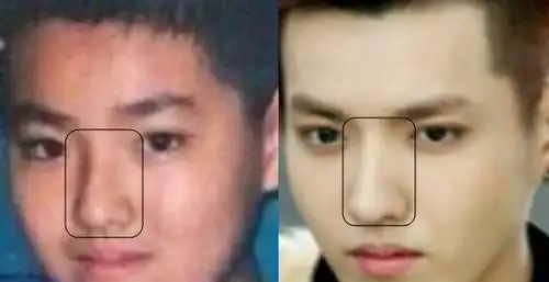 小鸡嘴逆天鼻梁吴亦凡整容没多图扒吴亦凡