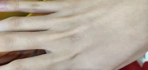 手背留疤了 还怎么办?都一年了疤痕还是很明显 ,用什么药膏可以治好?