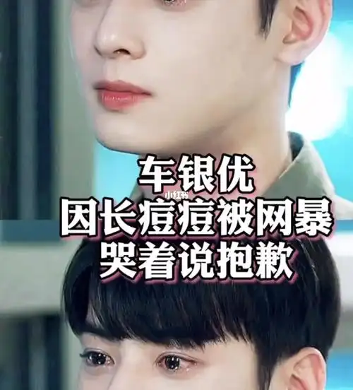 车银优因长痘被网暴