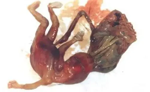 香港宫外孕专家_香港治疗宫外孕哪个专家好_香港治疗宫外孕最好的专家