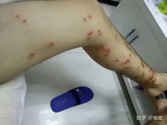 被跳蚤咬的全身都是包是什么样的感受