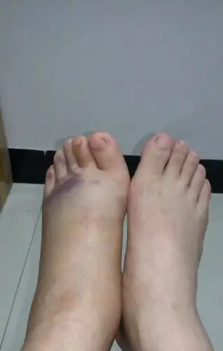 脚部第五趾骨骨折多久能走路