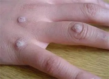 手指关节上长扁平疣江门可以治好吗,治扁平疣要多少费用?