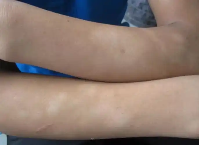 "白斑"不等于"白癜风" - 微医(挂号网)