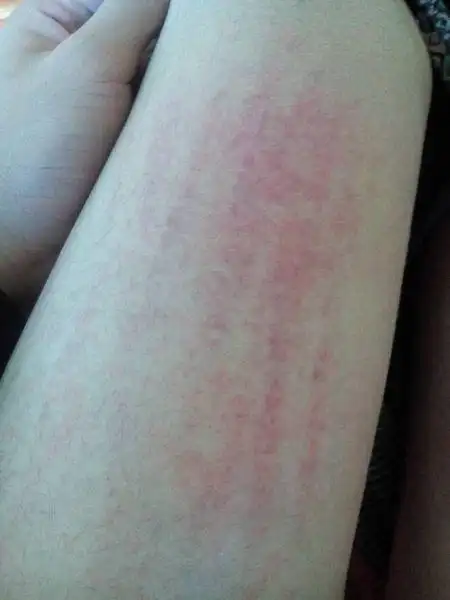 问:腿这是怎么了 ,是过敏吗 特别痒