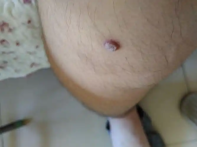 腿上长了一个疙瘩