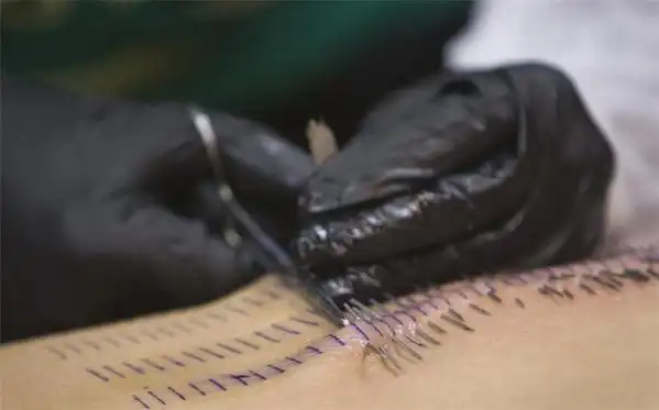 美女身体一次性穿刺3200枚针图