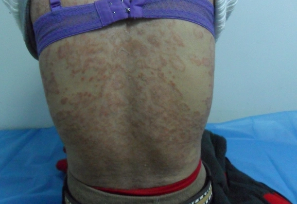 皮癣早期症状图片 (15)_有来医生