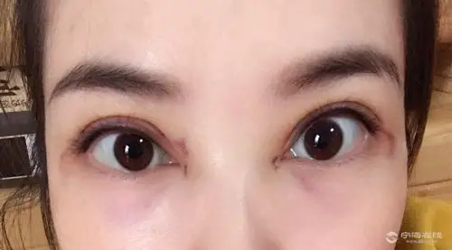 有没有割过双眼皮开眼角的探讨一下