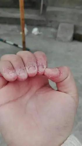 喜欢咬指甲,咬成这样,该怎么帮,本人13岁了,以后会好吗