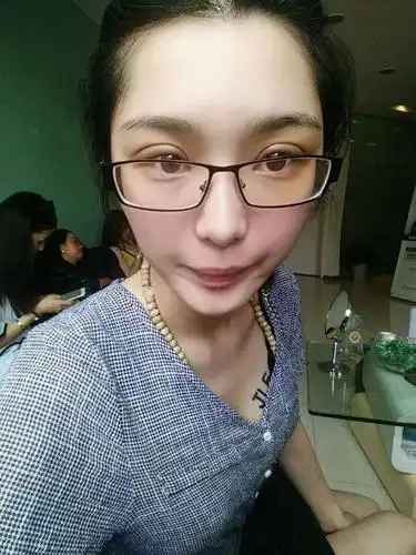 双眼皮恢复一个月,都说很自然了,嘻嘻