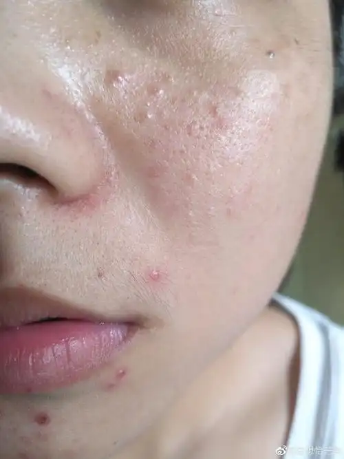 脸上长闭口粉刺下巴长闭口粉刺额头长闭口粉刺