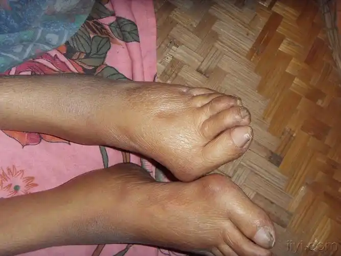 高度水肿十天余有图片