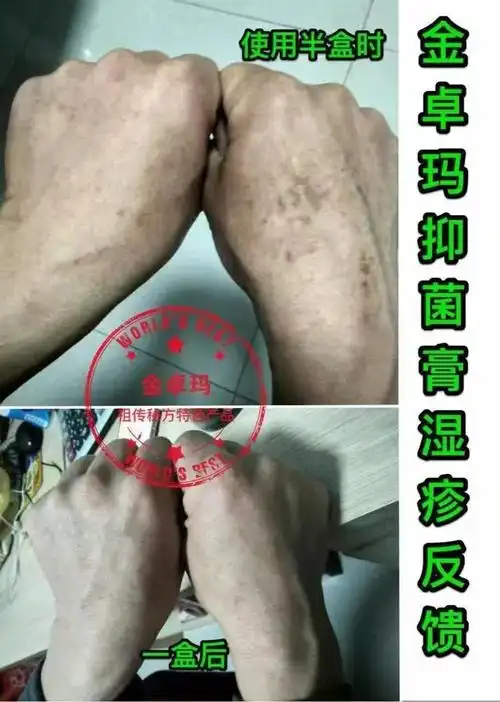 湿疹的分类和症状