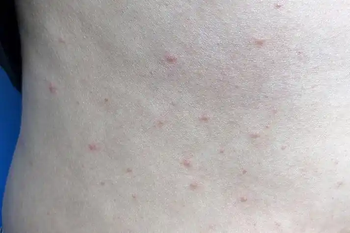 艾滋病初期小红点照片