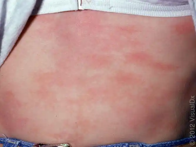 中央凸起,周围红晕,你肯定知道是什么问题,就是风疙瘩(风团,荨麻疹)啊