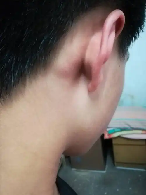 耳朵后面长拉个好像一个软骨一样的疙瘩 开始只有右耳有现在左耳也有