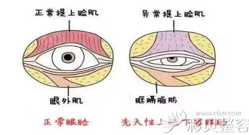 艾恩金承俊解答上睑下垂和提肌无力怎么改善是一回事吗